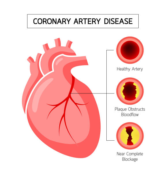 A picture showing coronary artery disease and take treatment at Santosh Homoeo Hall and Clinic