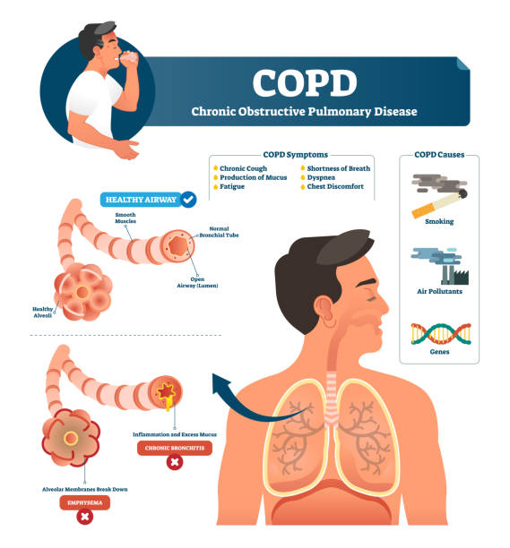 An info graphic of COPD at Santosh homoeo Hall and Clinic