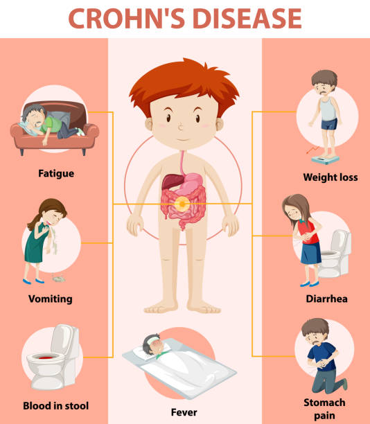 Image show description of Crohn's disease and homeopathic treatment at Santosh Homoeo Hall and clinic