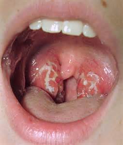 An image of diphtheria and treatment at Santosh Homeo Hall and Clinic