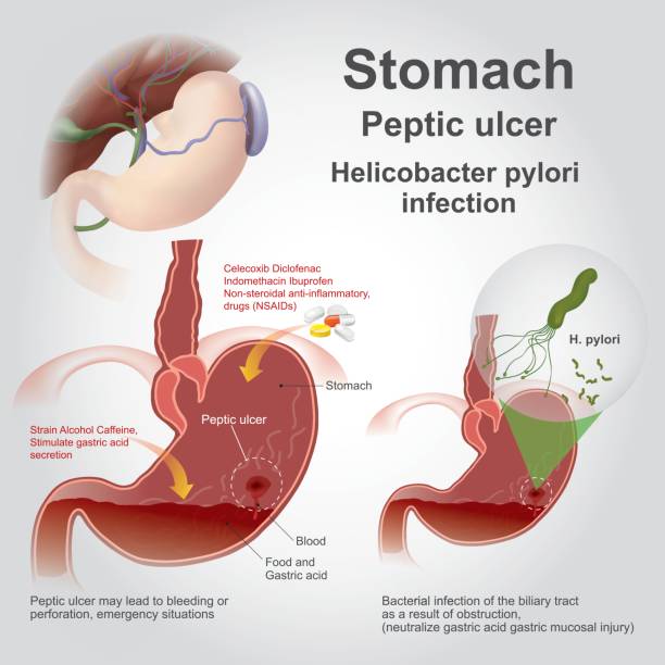 Image show gastric ulcer description and treatment at Santosh Homoeo Hall and clinic