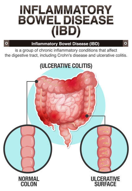 Image show IBD and homeopathic treatment at Santosh Homoeo Hall and Clinic