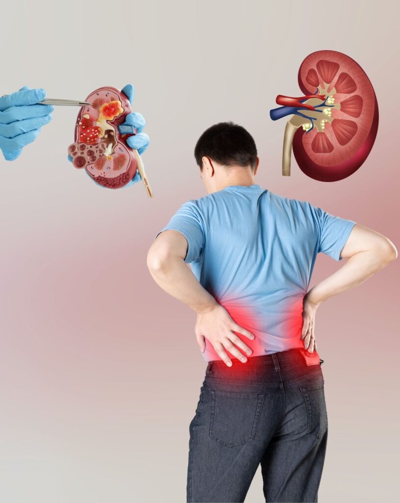 A man suffered from kidney stone pain and take homeopathic treatment at Santosh Homoeo Hall and clinic