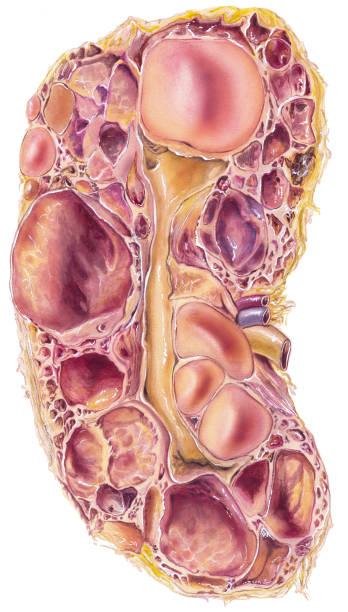 Image show polycystic kidney disease and take treatment at Santosh Homoeo Hall and Clinic