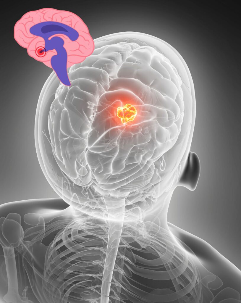 image shows treatment of pituitary gland tumour at santosh homeo hall and clinic