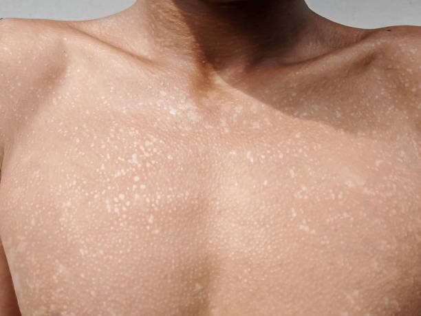 an image show pityriasis versicolor and treatment at santosh homeo hall and clinic