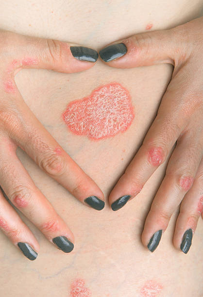 Psoriasis treatment at santosh homeo hall and clinic