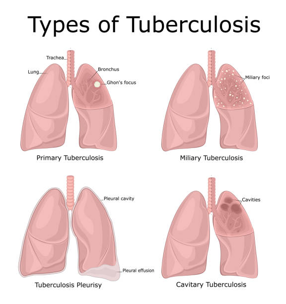 an image with types of tuberculosis and take treatment at Santosh homeo Holland clinic