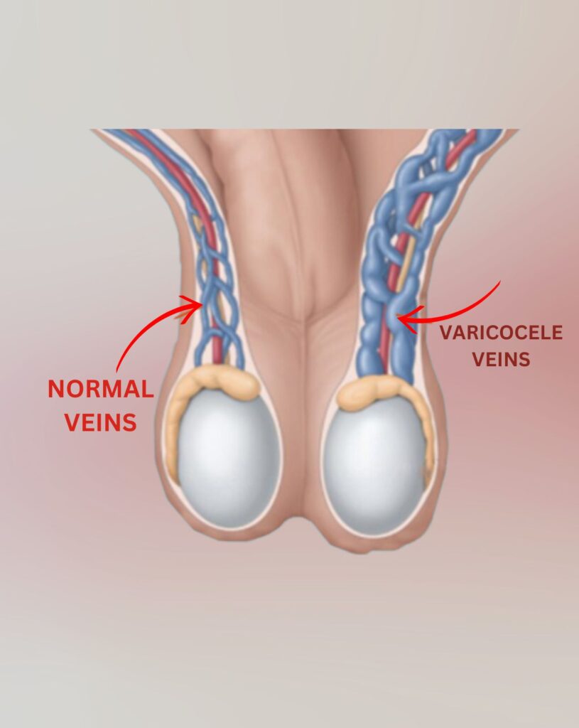 A picture show Varicocele and take homeopathic treatment at Santosh Homoeo Hall and Clinic