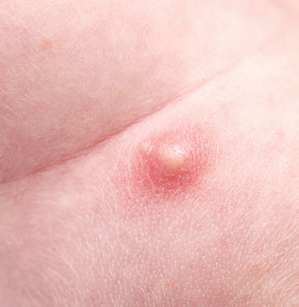 Image of abscess and treatment at Santosh Homeo Hall and clinic