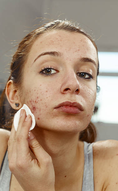 Picture showing acne vulgaris and treatment at Santosh Homoeo Hall and Clinic