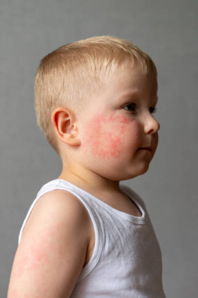 A boy show allergic eruptions on a face and treatment at Santosh Homoeo Hall and clinic