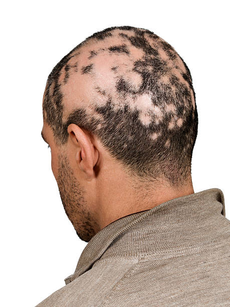 Image of alopecia and treatment at Santosh Homeo Hall and Clinic