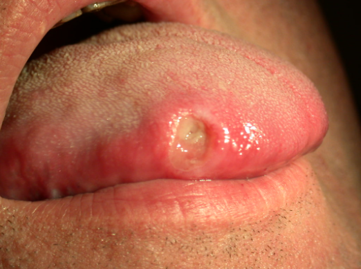 Apthae on tongue and treatment at Santosh homeo hall and Clinic