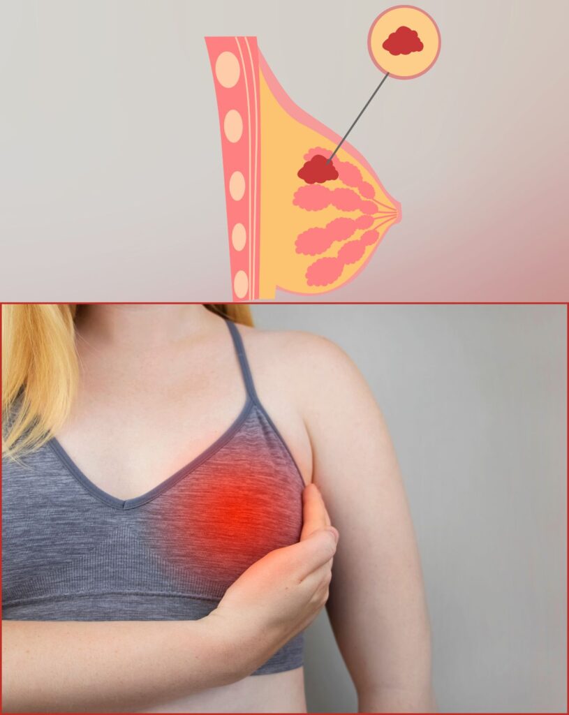 Image show breast lump and treatment at Santosh Homoeo Hall and clinic