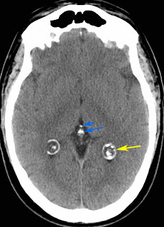 calcified cyst shows on ct scan of head treated at santosh homeo hall and clinic