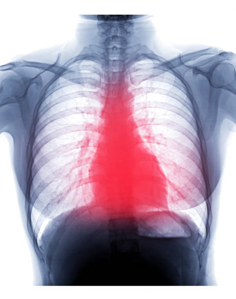 A picture of cardiomegaly and take treatment at Santosh Romeo Holland clinic