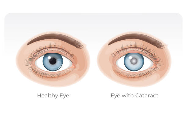 picture shows cataract treatment at santosh homeo hall and clinic