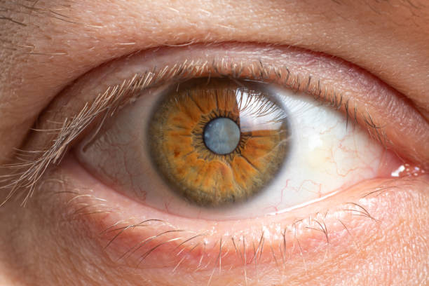 picture shows cataract tretament at santosh homeo hall and clinic