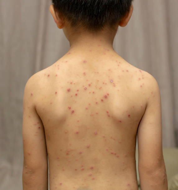 And eruption of chickenpox on a boy and treatment at Santosh, homeo Hall and Clinic