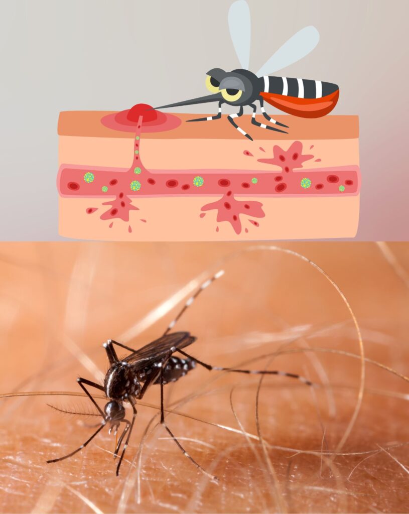 chikungunya virus shows on image with treatment on santosh homeo hall and clinic