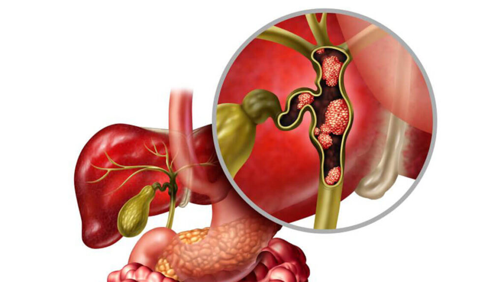 image show cholangiocarcinoma and homeopathic treatment at SANTOSH HOMEO HALL AND CLINIC