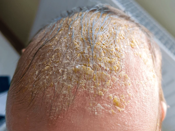 Image of crusta lactea and treatment at Santosh Homeo Hall and Clinic