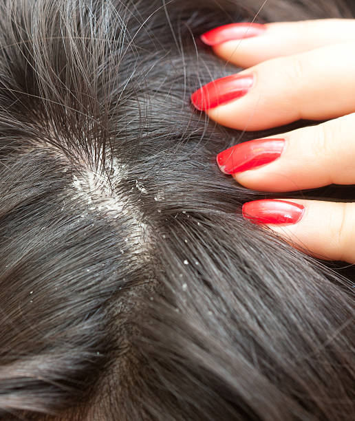 A picture of dandruff treatment at Santosh, homeo Hall and Clinic