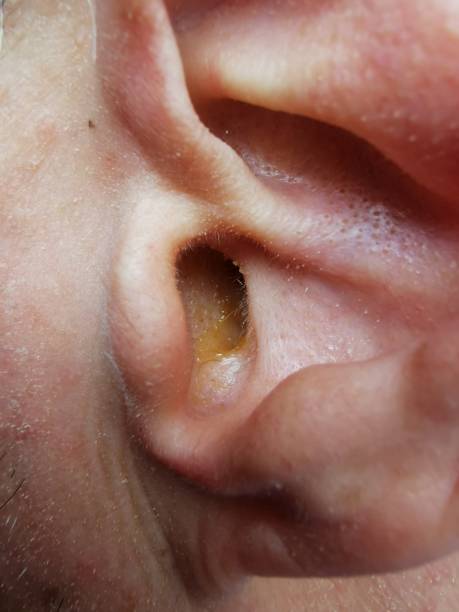 An image with ear discharge and treatment at Santosh Homeo Clinic