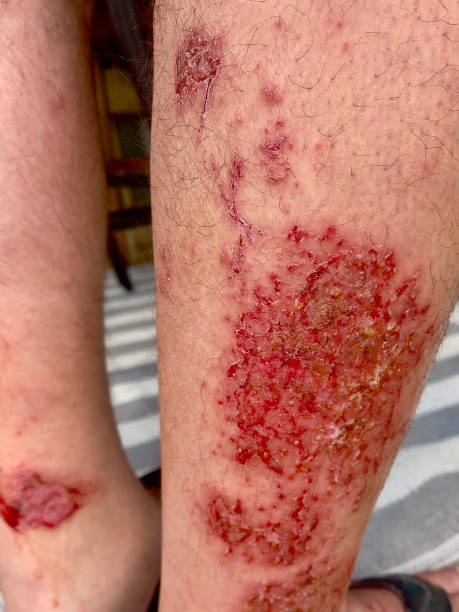 An image of eczema and treatment at Santosh Homoeo Hall and Clinic