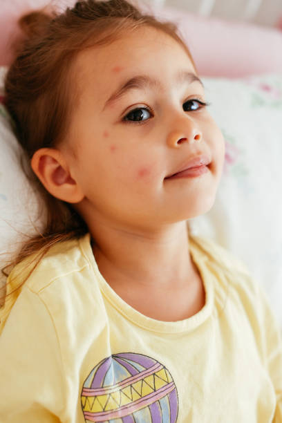 A small girl with eruption on a face and take treatment at Santosh homeo Hall and clinic