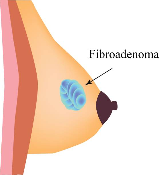 Image show fibroadenoma and treatment at Santosh homeo Hall and Clinic