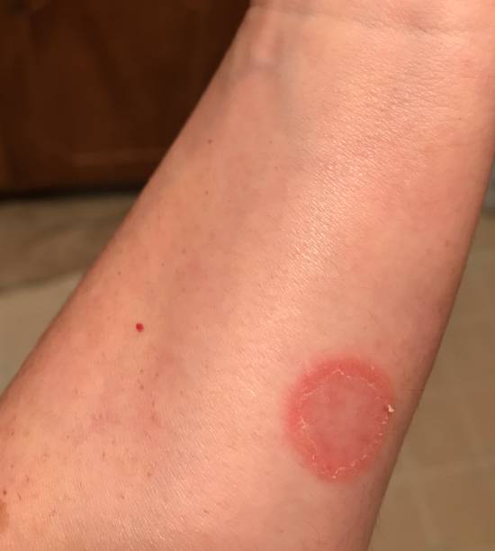 An image show fungal infection and treatment at Santosh Homeo hall and clinic