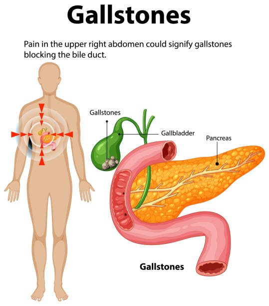 Image show gallbladder, stone and homeopathic treatment at Santosh homeo hall and clinic