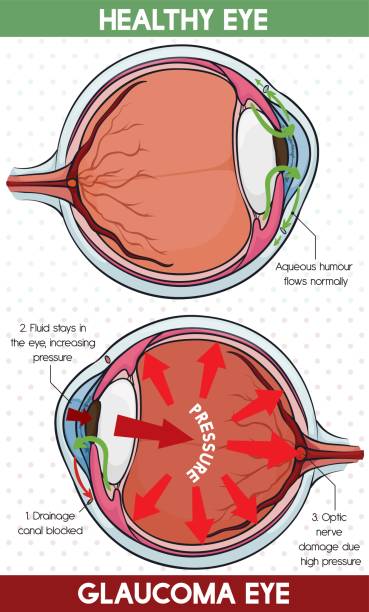 glaucoma image and treatment at santosh homeo hall and clinic