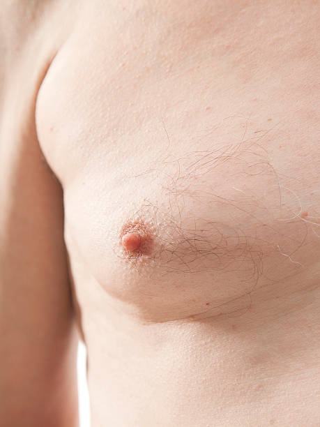 A picture of gynecomastia and treatment at Santosh Homoeo Hall and clinic