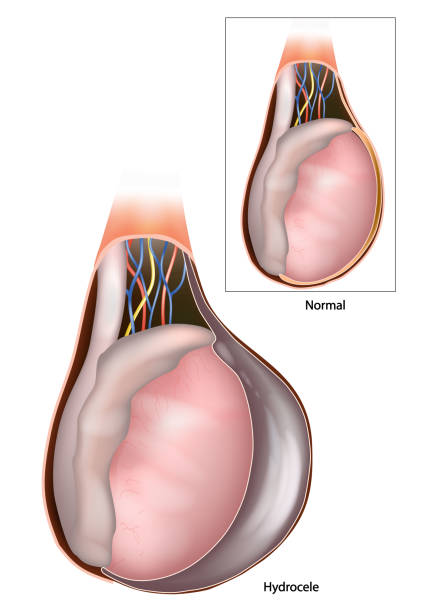 A picture of hydrocele and take homeopathic treatment at Santosh Homoeo Hall and clinic