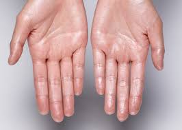 an hand palm shows excess sweating and treatment at santosh homeo hall and clinic