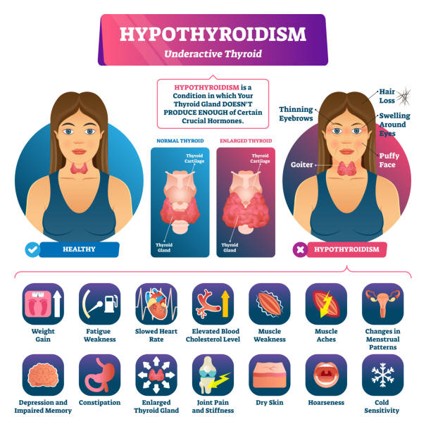 A picture show condition of hypothyroidism and treatment at Santosh Homoeo Hall and clinic