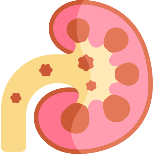 kidney stone