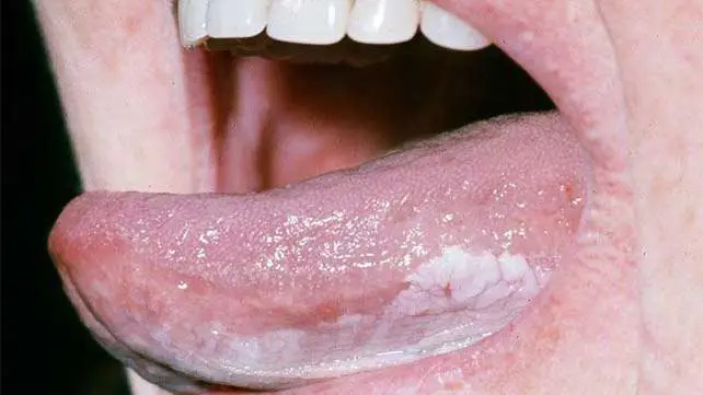 image showing leukoplakia and treatment at Santosh homeo Hall and Clinic