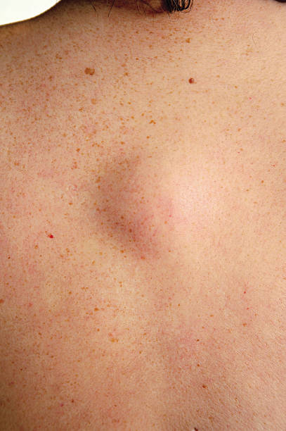 lipoma on back and treatment at santosh homeo hall and clinic