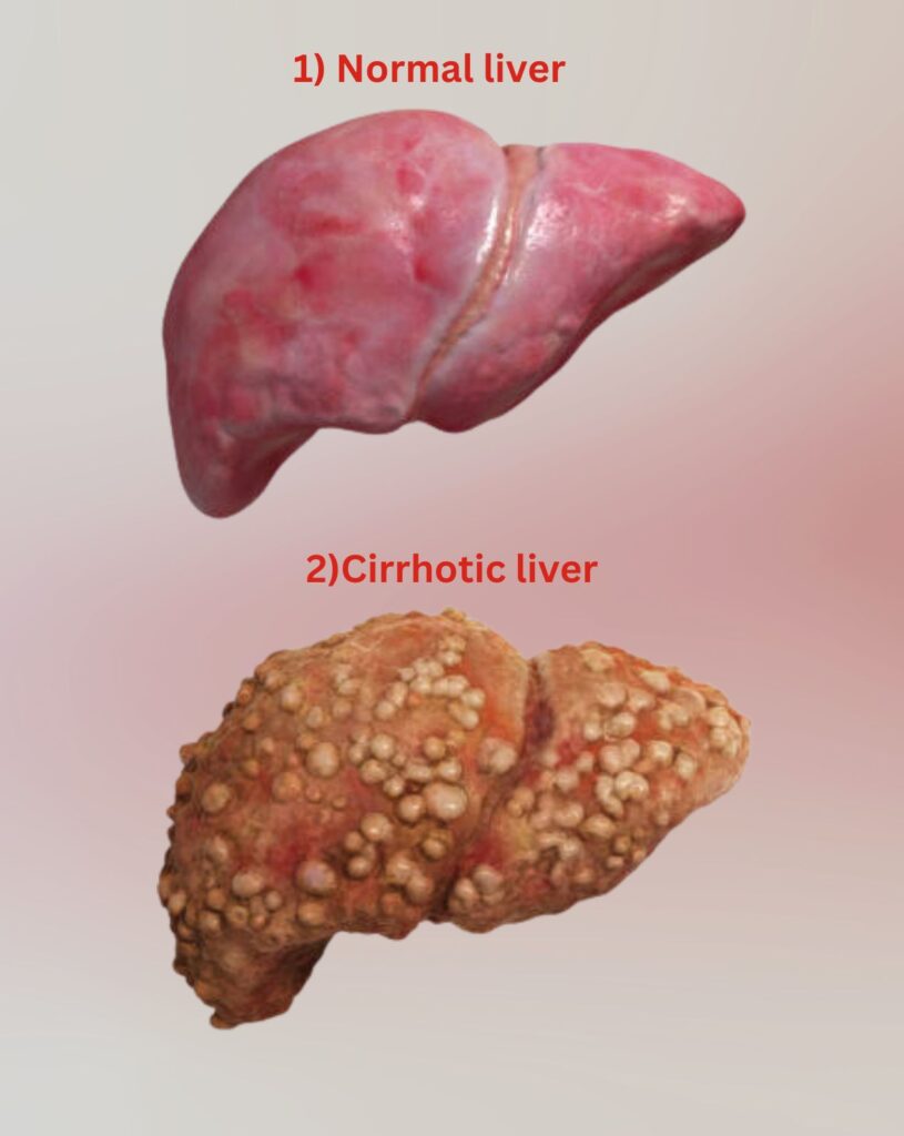 Image showing of healthy liver and liver cirrhosis and take treatment at Santosh homeo Hall clinic and clinic