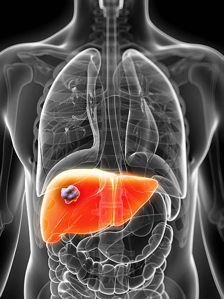 image showing liver cyst and take treatment at Santosh Homoeo Hall and Clinic