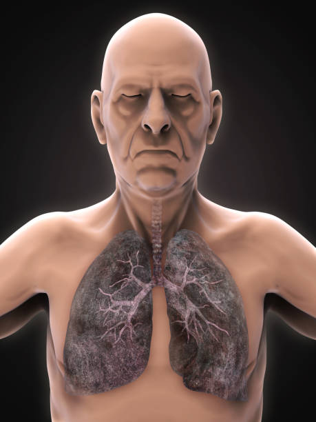 An old man with lung fibrosis and take treatment at Santosh Homoeo Hall and Clinic