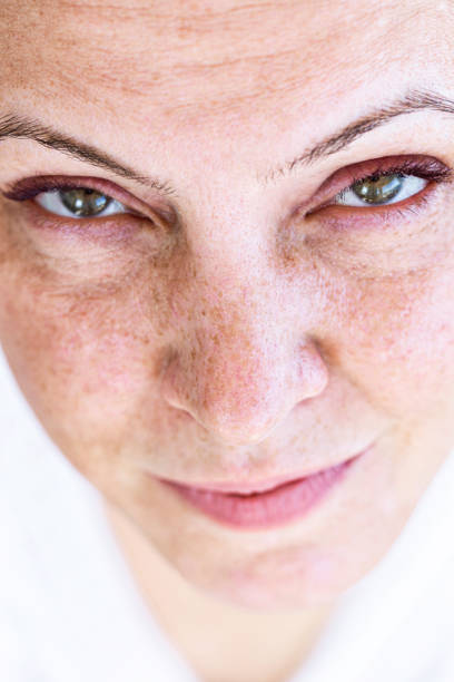 Already having melasma on face and take treatment at Santosh Homeo Hall and clinic