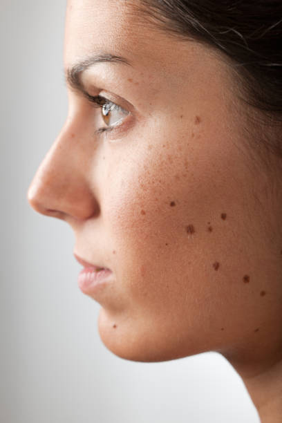 in image of mole on face and treatment at santosh homeo hall and clinic