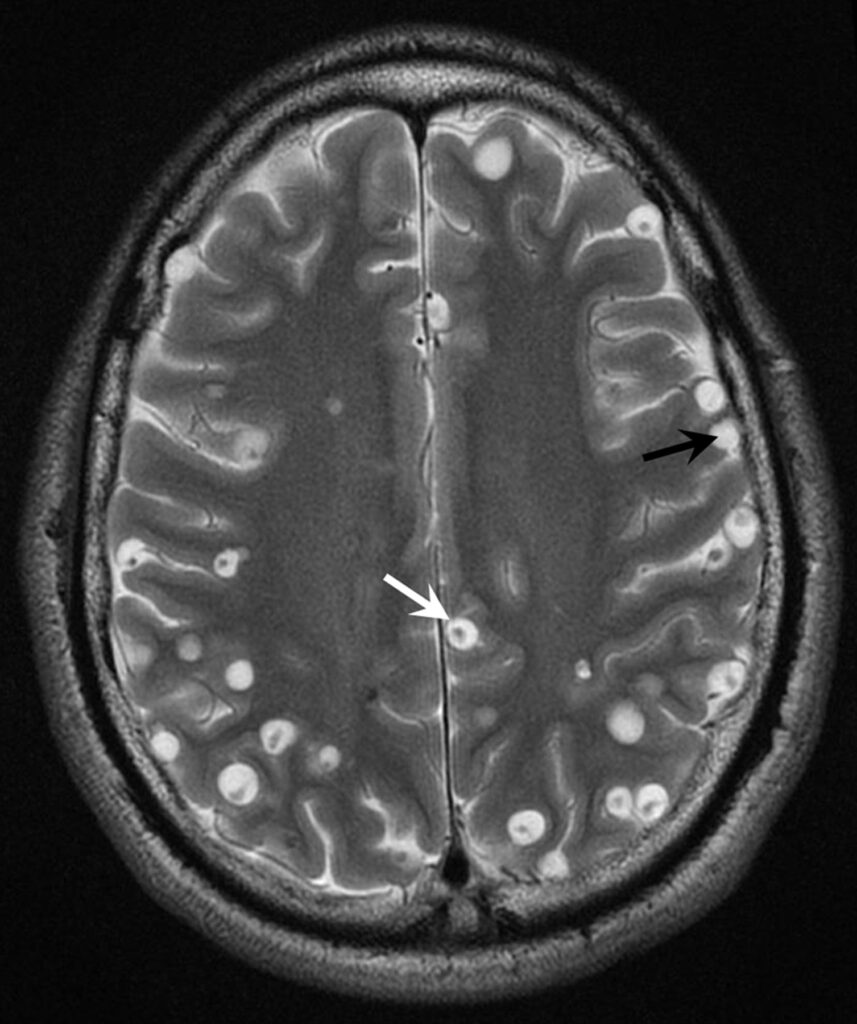 image shows neurocysticercosis and treatment at santosh homeo hall and clinic