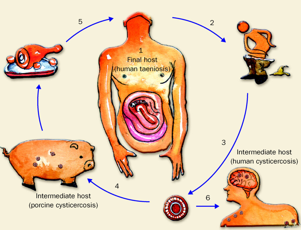 image shows neurocysticercosis development and treatment at santosh homeo hall and clinic