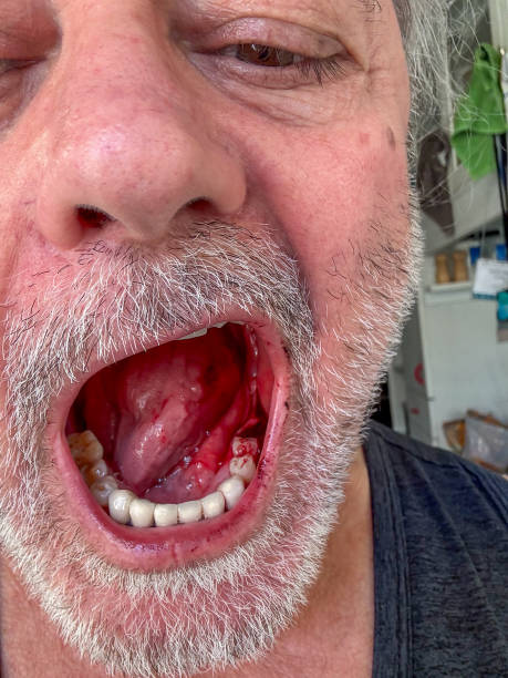 Image of oral cancer and treatment at Santosh Homeo Hall and Clinic